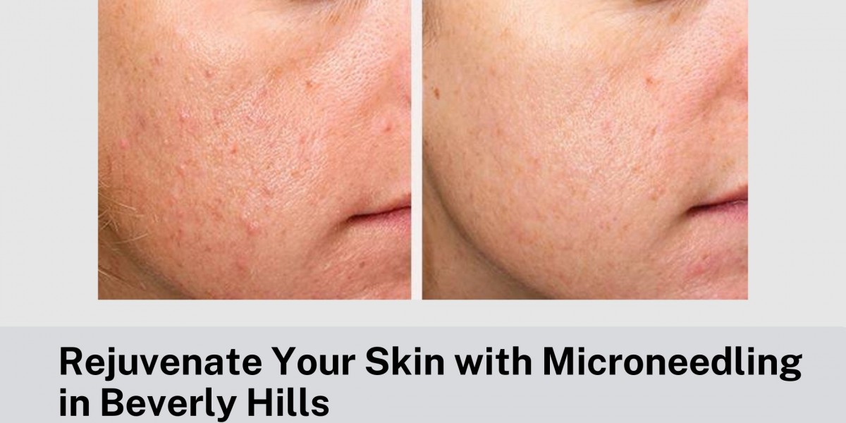 Rejuvenate Your Skin with Microneedling in Beverly Hills