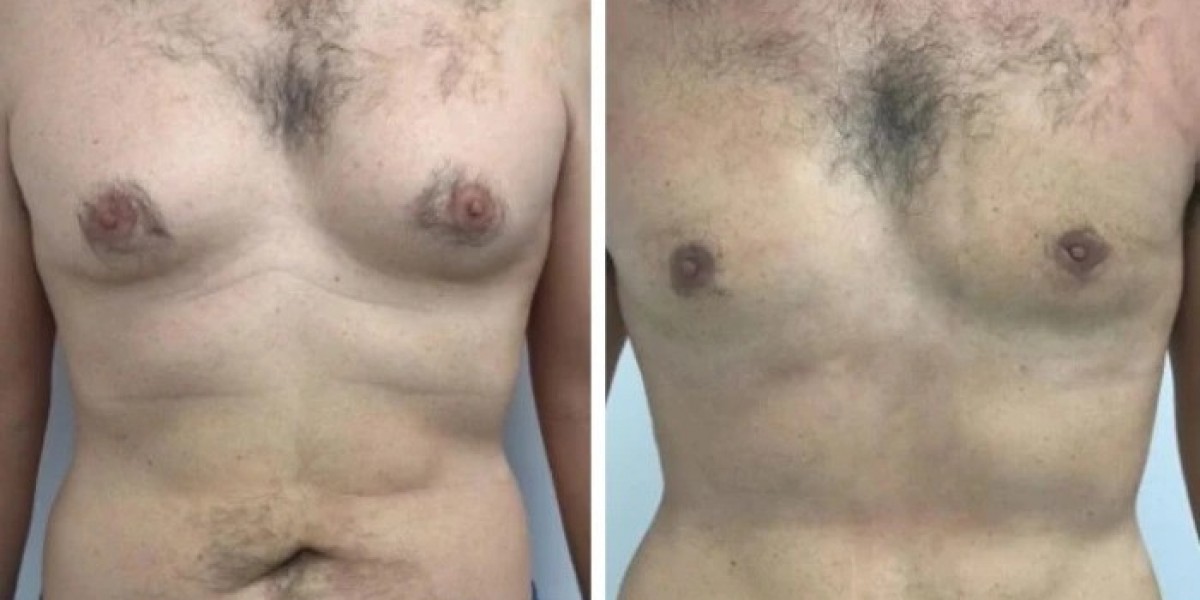The Impact of Weight Fluctuations on Gynecomastia in Dubai