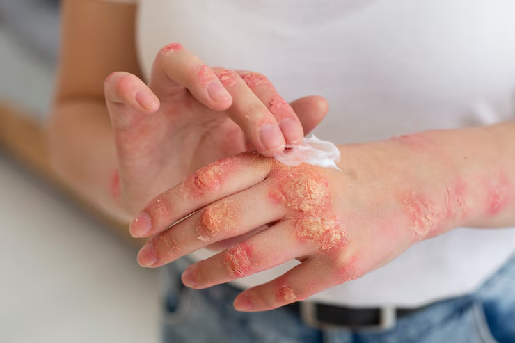 Simple Steps to Use Eczema Cream During Daily Routine