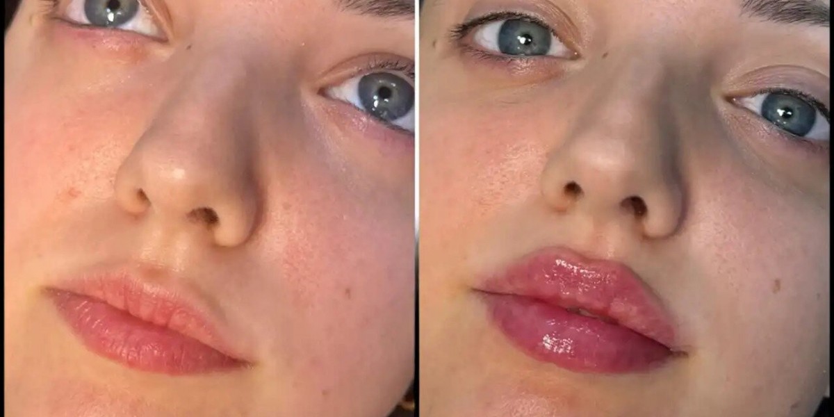 Fillers Treatments in Dubai for Younger-Looking Skin