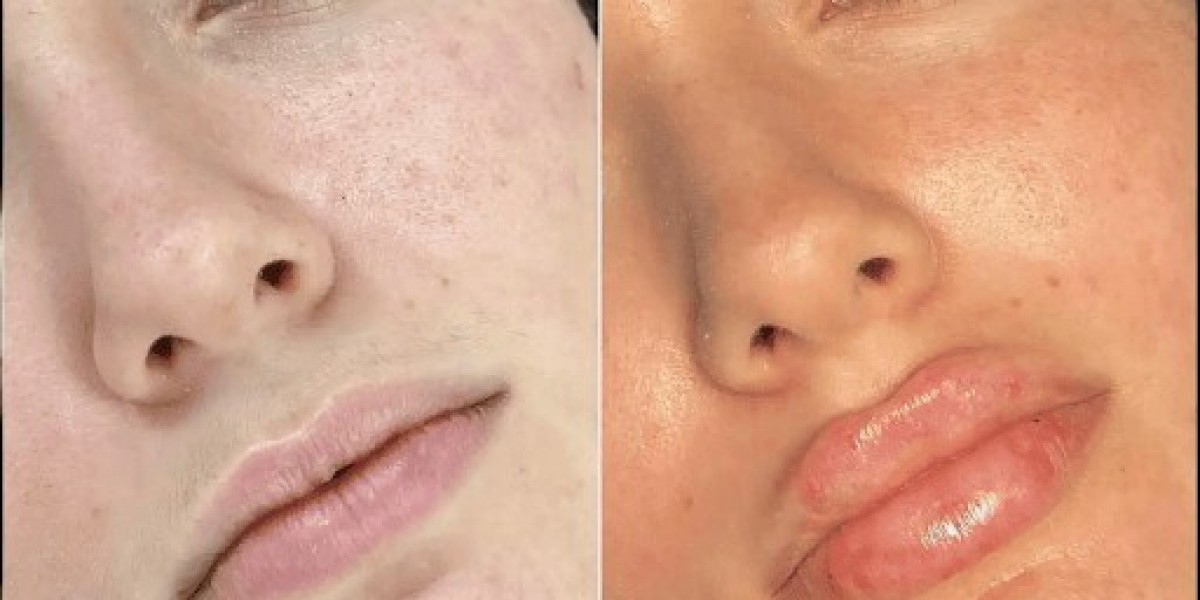 Maintaining Natural Beauty with Fillers in Dubai