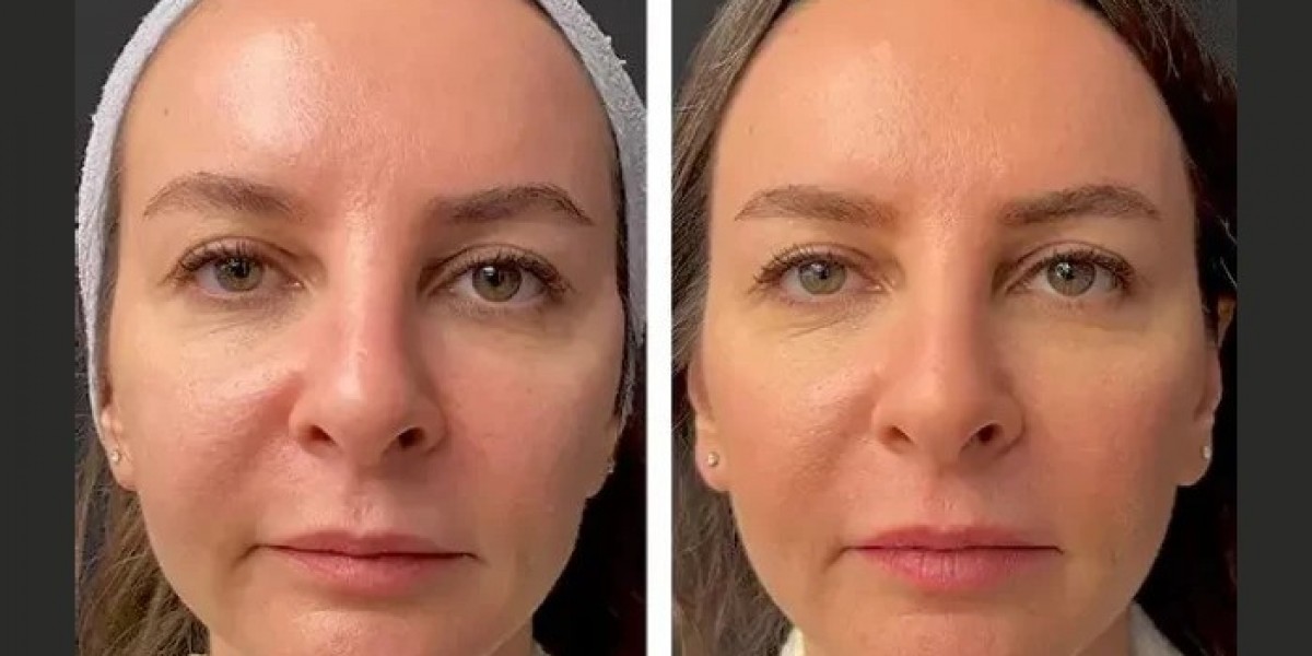 Mesotherapy for Fat Reduction: Techniques by the Best Plastic Surgeons in Dubai