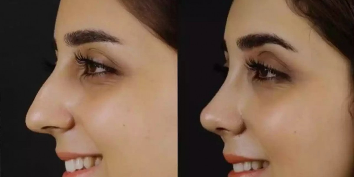 Nose Deviated Septum Surgery in Dubai: Safe, Proven, Effective